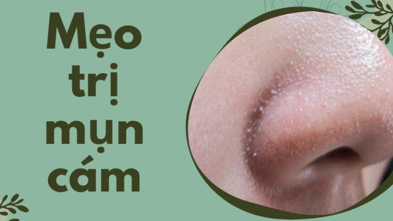 Mẹo trị mụn cám giúp da mịn màng chỉ sau 7 ngày áp dụng!